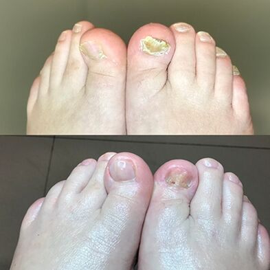 Tapasztalat a Promicil Cream Barnabas használatában, Izraelből, fotó előtt és utána