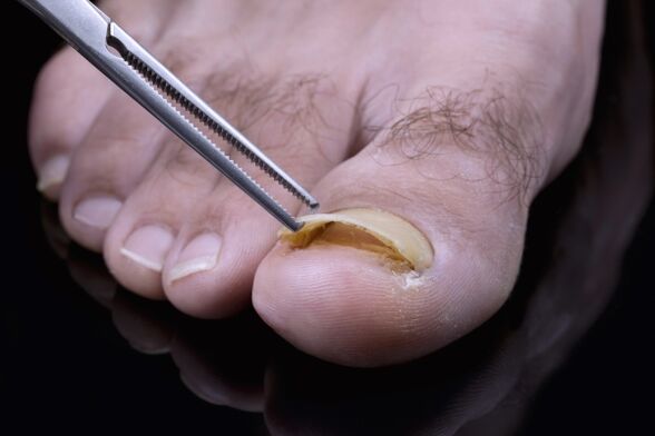 A betegség lefolyásának atrofikus változata