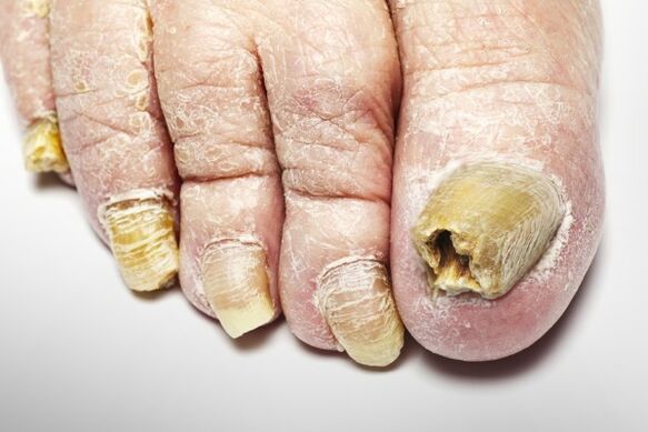 A körömgomba teljes verziója