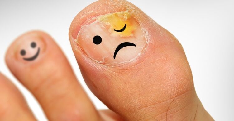 Hogyan lehet felismerni a körömgomba