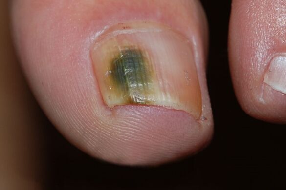 penészes típusú körömgomba