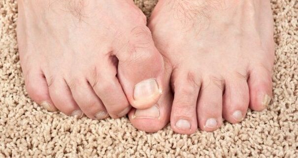 A körömgomba tünetei