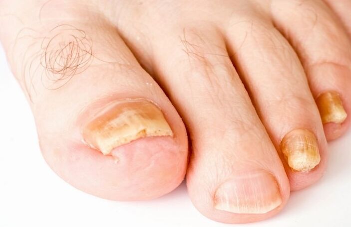 A gomba a láb hüvelykujján