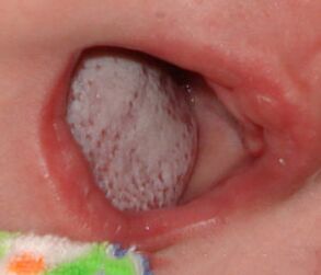 A betegség lokalizációja gomba segítségével