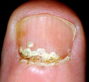 A betegség tünetei és jelei