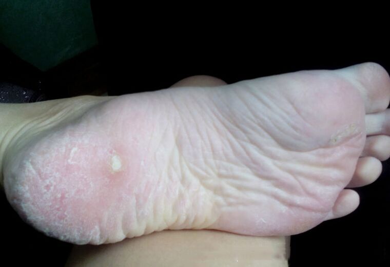 A gomba lézerrel történő kezelése