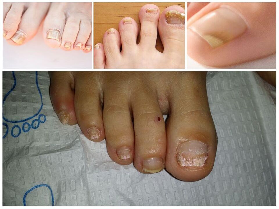 A körömlemezek gombás betegségei