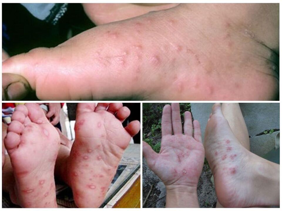 A láb hiperkeratotikus elváltozásai