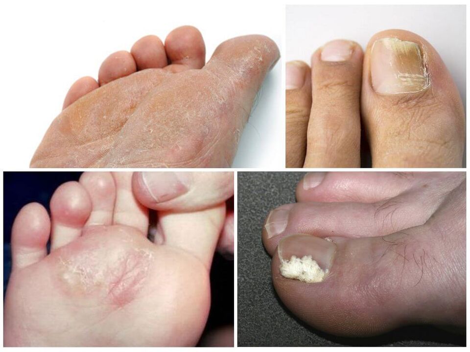 A lábgomba kezdeti szakasza