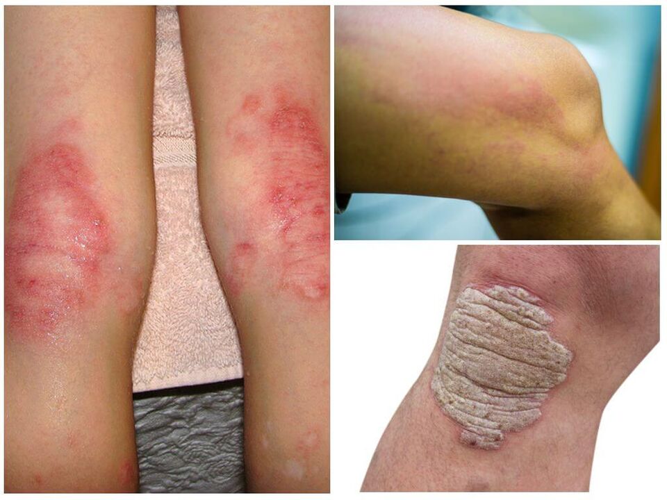 A térd gombás fertőzései