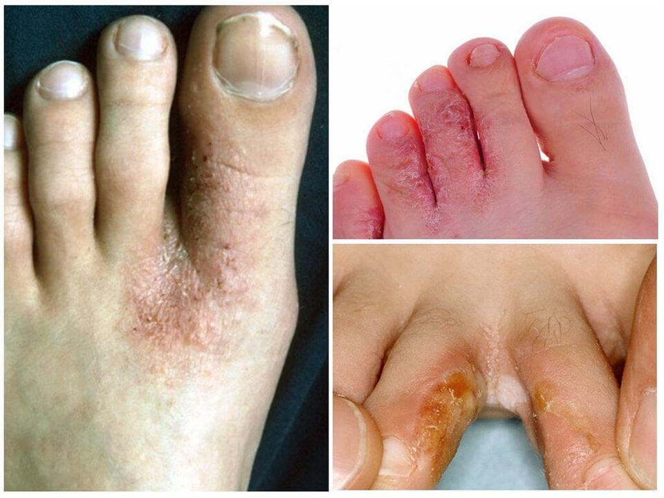 Interdigitális mycosis