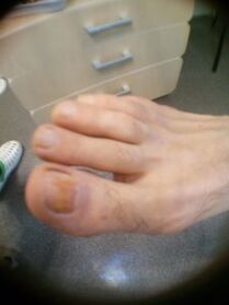 a nagylábujj köröm gomba kezdeti stádiuma