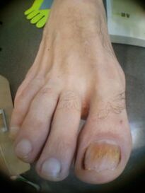 nagylábujj köröm gomba