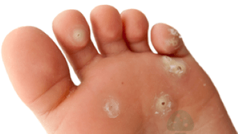 a gombás fertőzés második szakasza