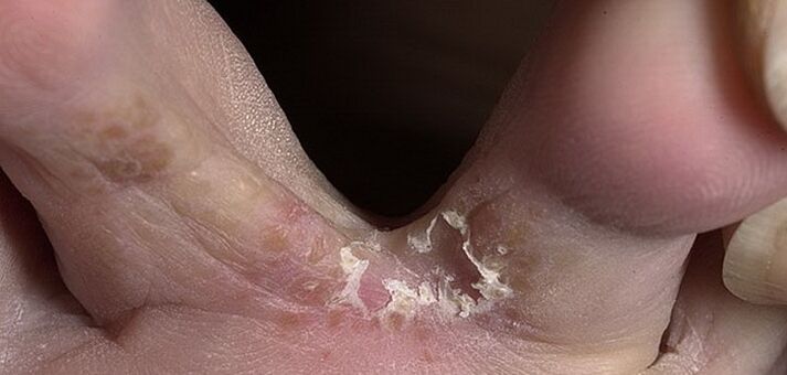 gomba a lábujjak között