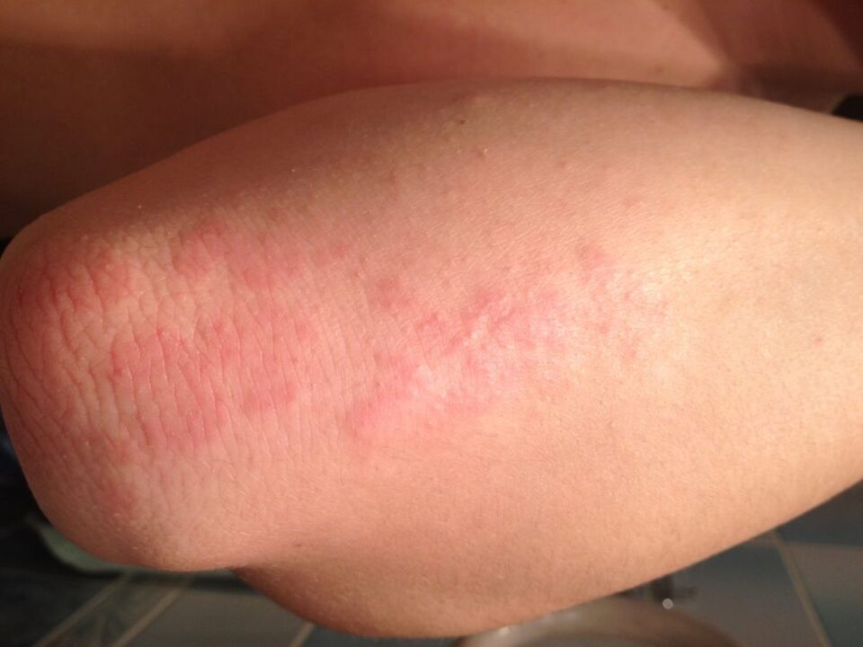 Allergiás reakció kiütés formájában a könyök bőrén egy csepp celandinlé alkalmazása után