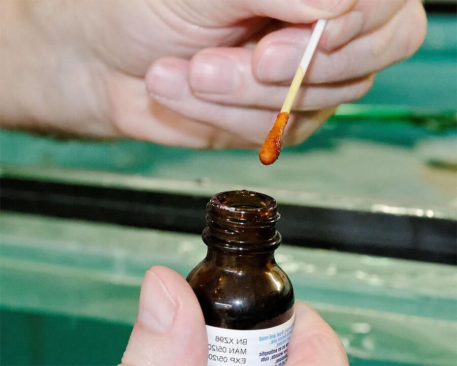 Ha jód és celandinlé keverékét alkalmazza a körmökre, megszabadul a gombától